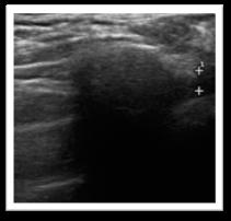 with complaints of claudication pain to the right upper limb. Provocative maneuver did not cause parasthesia.