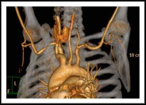 Findings : There was reduction of Subclavian artery size as depicted below : Fig 10b