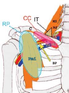 CERVICAL RIB (RIGHT). DISCUSSION: The term thoracic outlet syndrome was coined by Peet et al in 1956 to indicate compression of the neurovascular structures crossing the thoracic outlet.