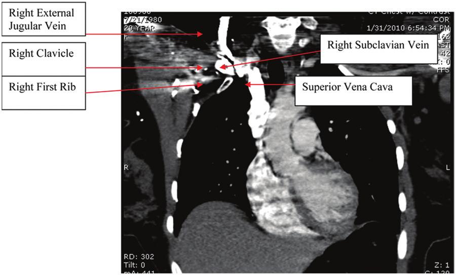 Upon hyperextension and upper extremity elevation maneuvers, the right axillary and subclavian venous flow transitioned from normal to high-grade subclavian obstruction at the clavicle first rib
