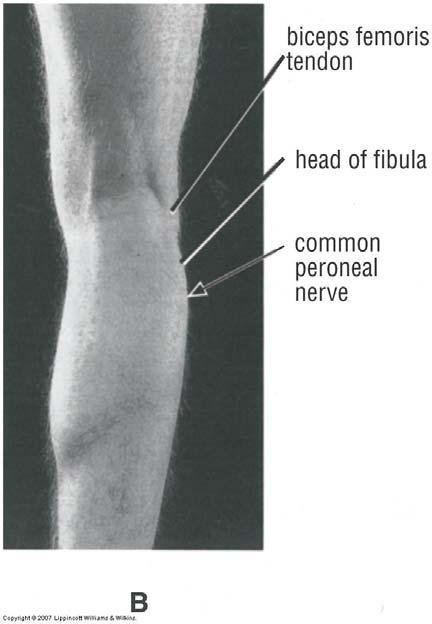 Common Peroneal Nerve Block Area: anterior and lateral sides of leg and the