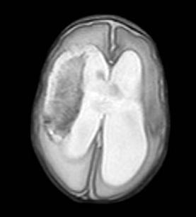 Case example Patient transferred to AH MRI done
