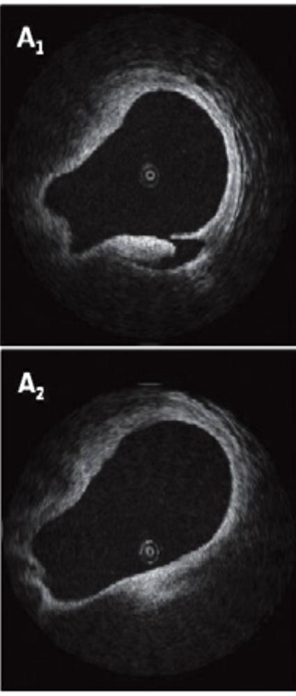 12 Months Baseline Natural History of OCT Detected Edge Dissections Following DES Implantation All not angiographically visible Median (IQR) Length, mm 2.9 (1.6-4.