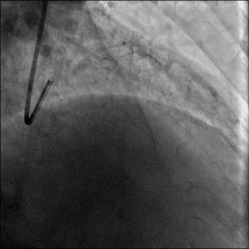 Challenging Technical Cases: Stent Failure, ACS Sidebranch