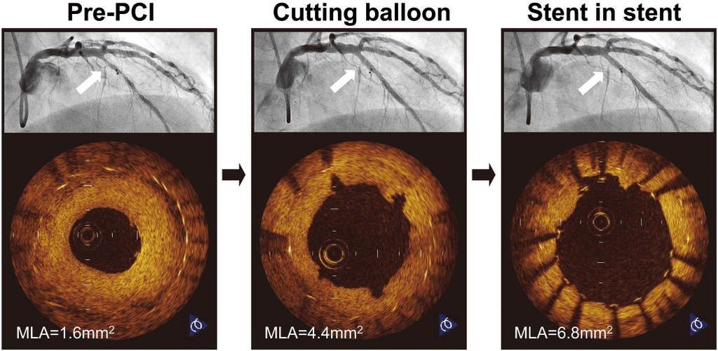 OCT in PCI for in-stent restenosis Pre-PCI Cutting balloon Stent
