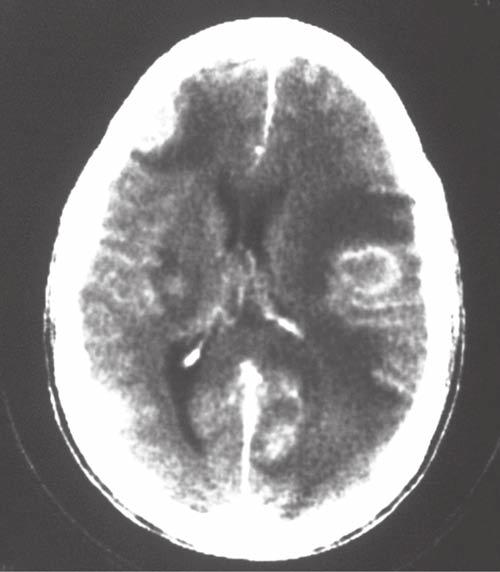 A, Computed tomography (CT) scan of an infant born with congenital toxoplasmosis, illustrating