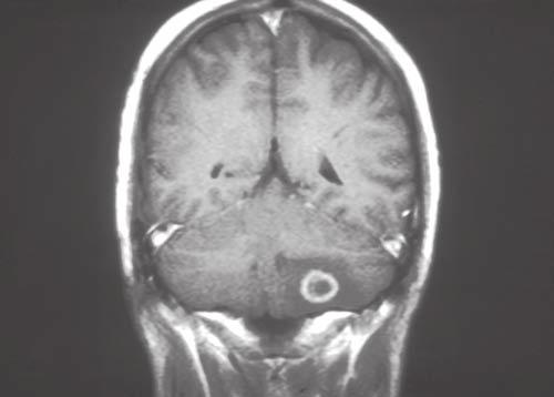 B, CT scan with contrast enhancement (left) and T2-weighted magnetic resonance imaging (MRI)