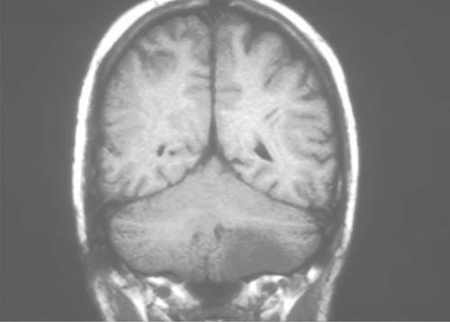encephalitis, demonstrating multiple lesions, which are more easily identified in the MRI scan.