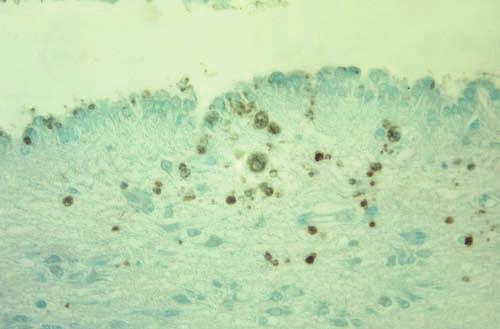 B, Positive immunoperoxidase stain of a brain biopsy specimen in a patient with acquired immunodeficiency syndrome and toxoplasmic encephalitis.