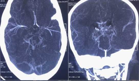 Neuroimaging CT Angiogram- bilateral ICA stenosis with