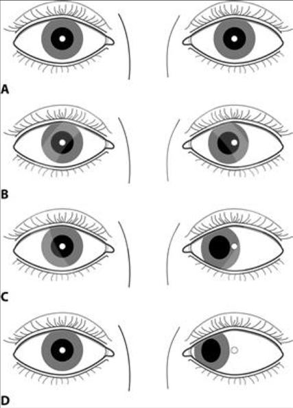 Ocular Examination Alignment and Ocular Motility Check Cranial Nerves III, IV, VI.