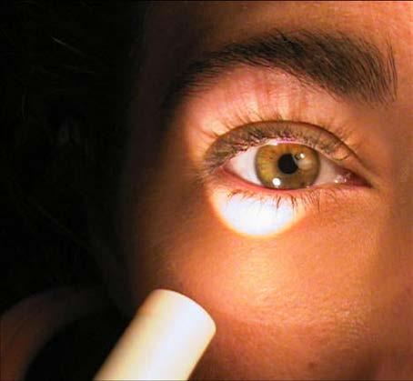 Ocular examination Ocular Examination Pupils Size, shape Response to direct and consensual light Check for an relative afferent pupillary defect.