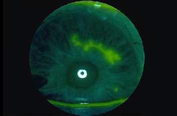 indicative of damage to the corneal