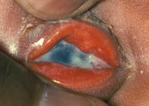 Conjunctivitis Inflammation or infection of the membrane lining the eyelids Age and presentation will dictate management