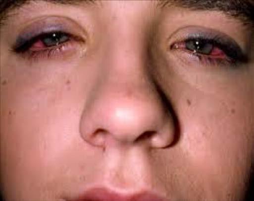 Adenoviral conjunctivitis Acute onset watery discharge, photophobia and a foreign body sensation. Usually will present around time of URI symptoms.