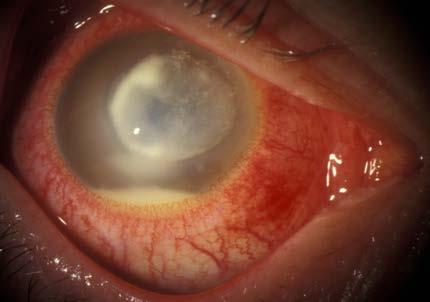 Corneal Ulcers Infection of the