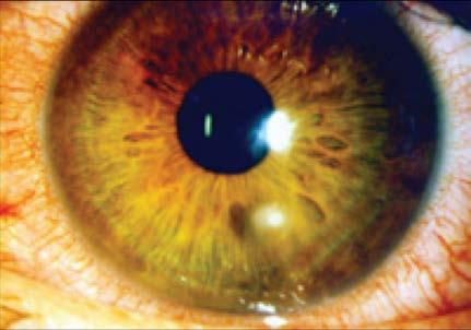 Corneal Abrasions Contact lens use.
