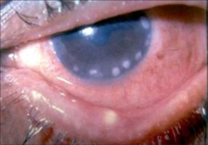 Marginal Keratitis Inflammation of the cornea usually due to blepharitis. Located near the limbus.