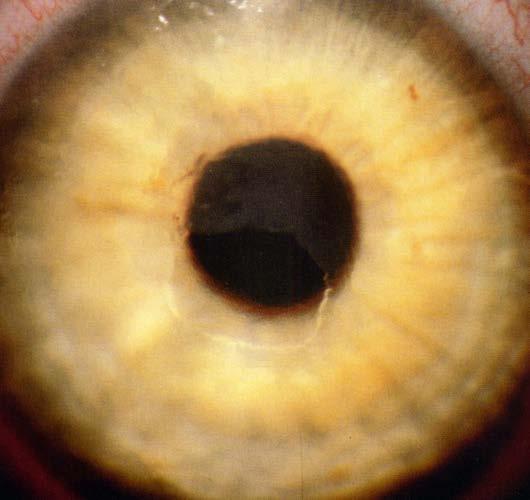 Corneal Abrasions Corneal epithelial defect