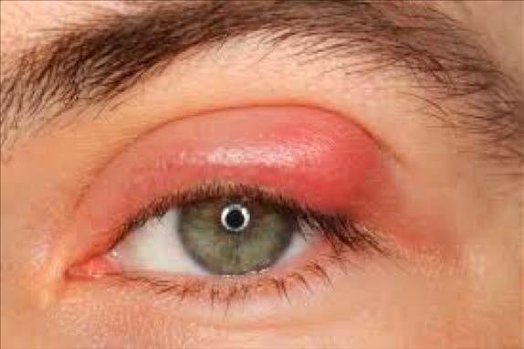 Chalazion A localized bump on the eyelid due to blockage of