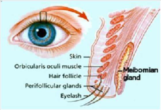 (oil glands) This is different from a stye or a hordeolum