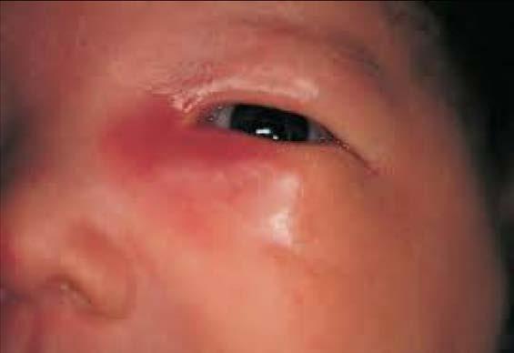 Three main routes Direct inoculation with eyelid trauma i.e. insect bites.
