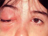Orbital Cellulitis Symptoms: Decreased vision Pain with eye movements Diplopia Signs: Fever Lid erythema and edema Proptosis