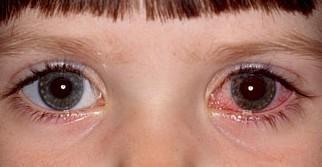Traumatic Iritis: Inflammation of the Iris Following Trauma Pupil
