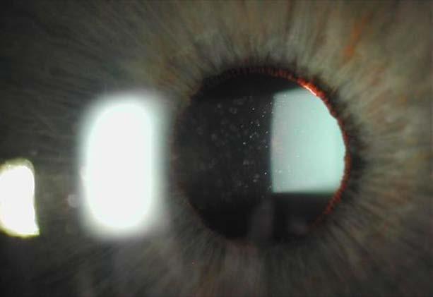 (ciliary flush, limbal flush) Slit lamp exam: cells in the