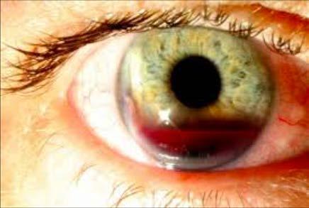 Hyphema: Blood in Anterior Chamber Due to