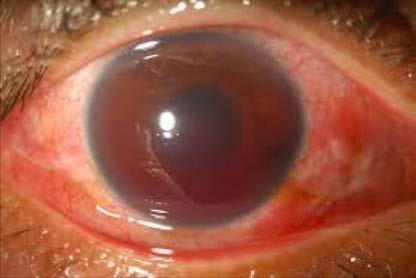 globe injuries Glaucoma risk check eye