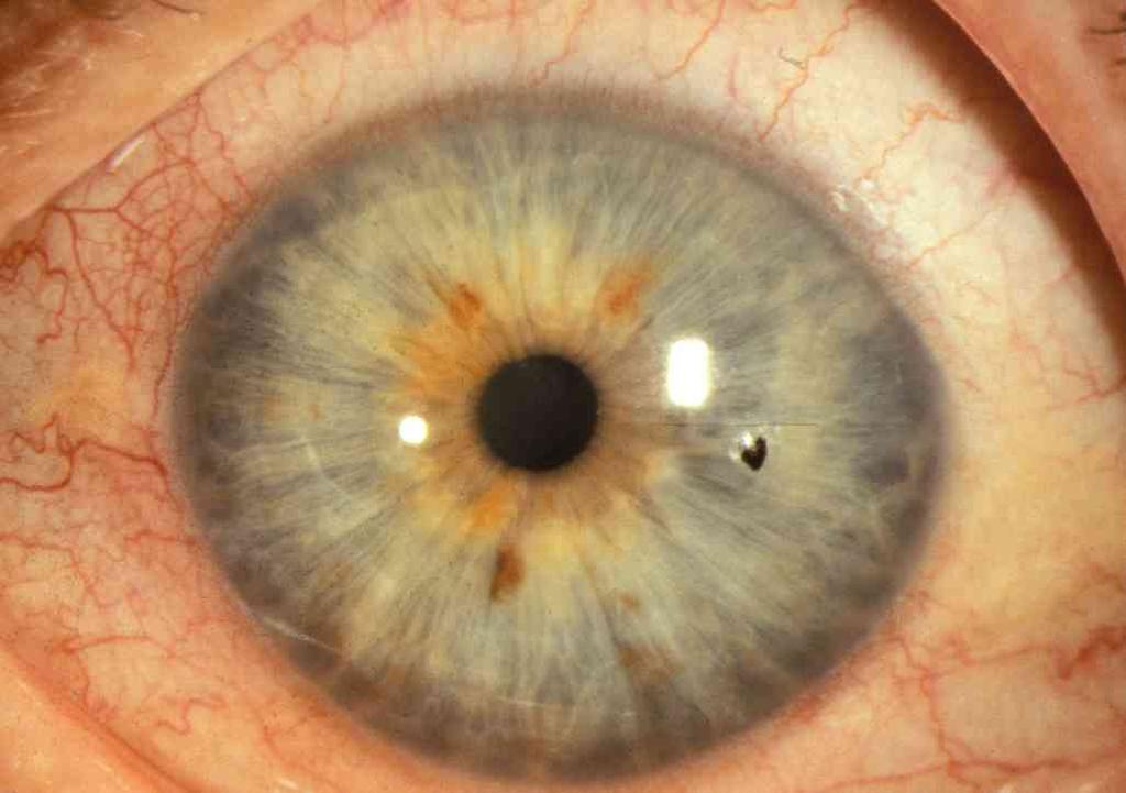 Corneal Foreign Bodies History of trauma or sudden onset foreign