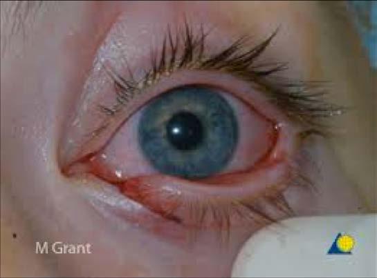 Eyelid Lacerations Usually due to dog bites, trauma. Determine if full vs.
