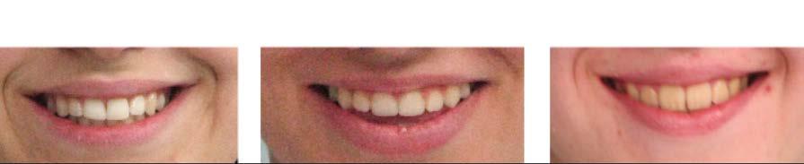 SMILE APPRECIATED BY LAYPERSONS Figure 4 Variants for posterior smile height D Figure 5 Variants for the last visible maxillary tooth during smile actions Figure 6 Variants for the percentage of