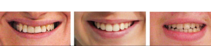 medium smile-showing 75% - 100% of the first maxillary premolar C. reduced smile-showing less than 75% of maxillary first premolar visible (Fig. 4).