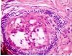 Incisional biopsy was performed, histologically H and E stained section reveals dense fibrocellular connective tissue showing follicles of odontogenic epithelium with stellate reticulum like cells,