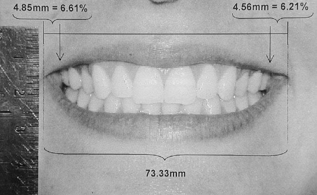 ESTHETIC INFLUENCE OF NEGATIVE SPACE DURING SMILE 199 FIGURE 1. Method used to mesure the smile width nd right nd left negtive spces in millimeters nd in percentge.