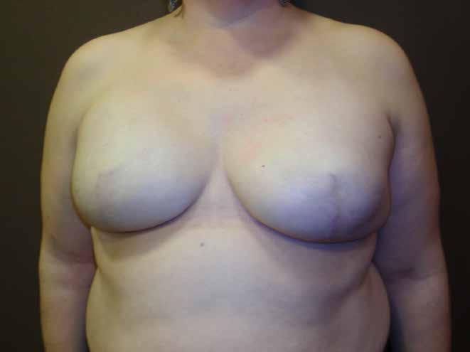 Skin sparing mastectomy