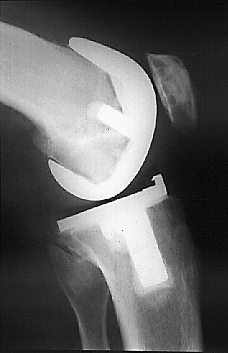 Femur (thigh bone) Patella (knee cap) Femoral component Tibial component Tibia (shin bone) Figure 7. Joint replacement surgery is now very successful.