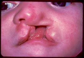 Cleft Lip Results