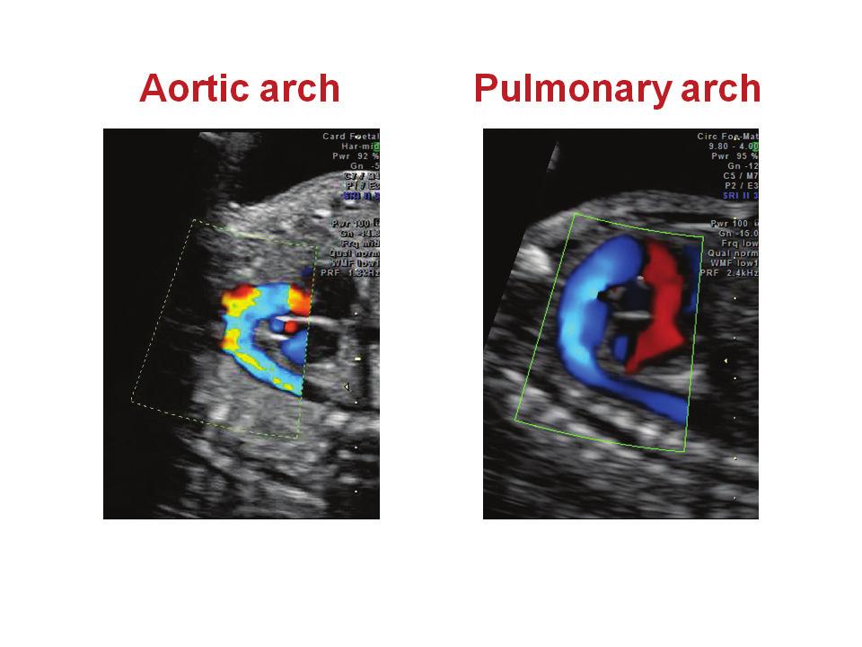 Why the fetal aortic isthmus?