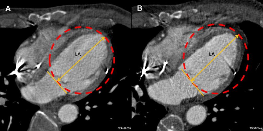 Figure 11. Reversal of remodeling as reduction of sphericity index in the POSEIDON trial. A, Four chamber MDCT images of a chronic ischemic cardiomyopathy patient with a sphericity index of 0.