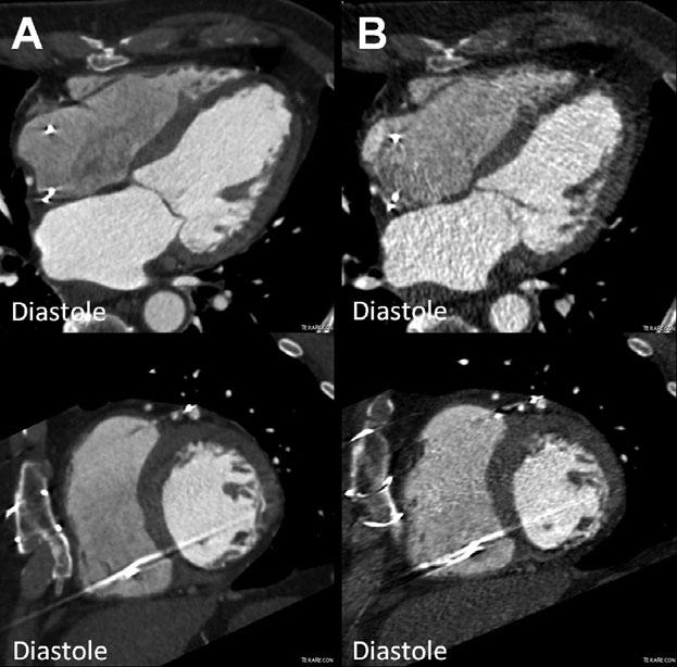 Figure 2. Reduction of left ventricular end-diastolic volume (EDV) in the POSEIDON study.