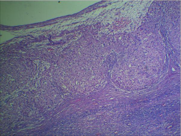 Sections from the cystic mass attached to the tube showed ovarian tissue forming parts of cyst wall, with subcortical follicle formation