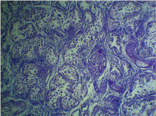 Fig 6: Glandular proliferation (10X, H&E) Fig 7: Glands lined by mucinous epithelium (40X, H&E) Fig 8: Calcification (40X, H&E) Discussion The incidence of an additional ovary is very rare being