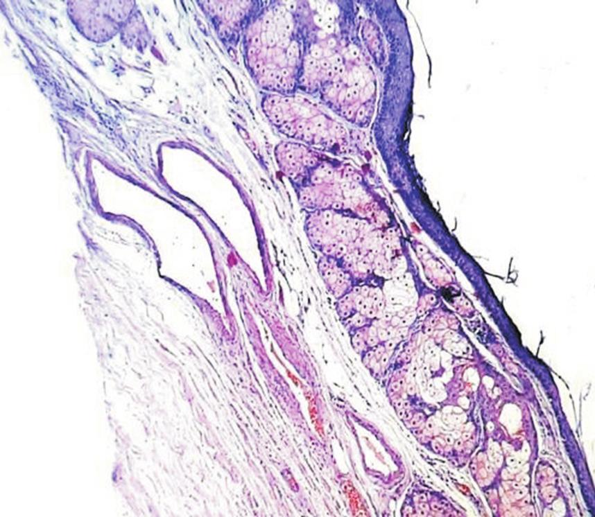 Discussion In the present case, histology showed multiple synchronous lesions in the genital tract- grade 1 endometrioid adenocarcinoma