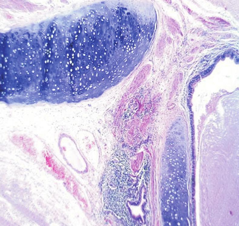 ovary - a sex cord stromal tumor of benign pure stromal tumor category and adenomyosis of the uterus which is ectopic placement of