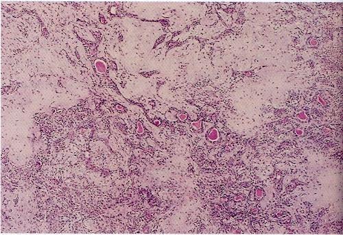 Mixed tumor or the parotid gland contains epithelial cells