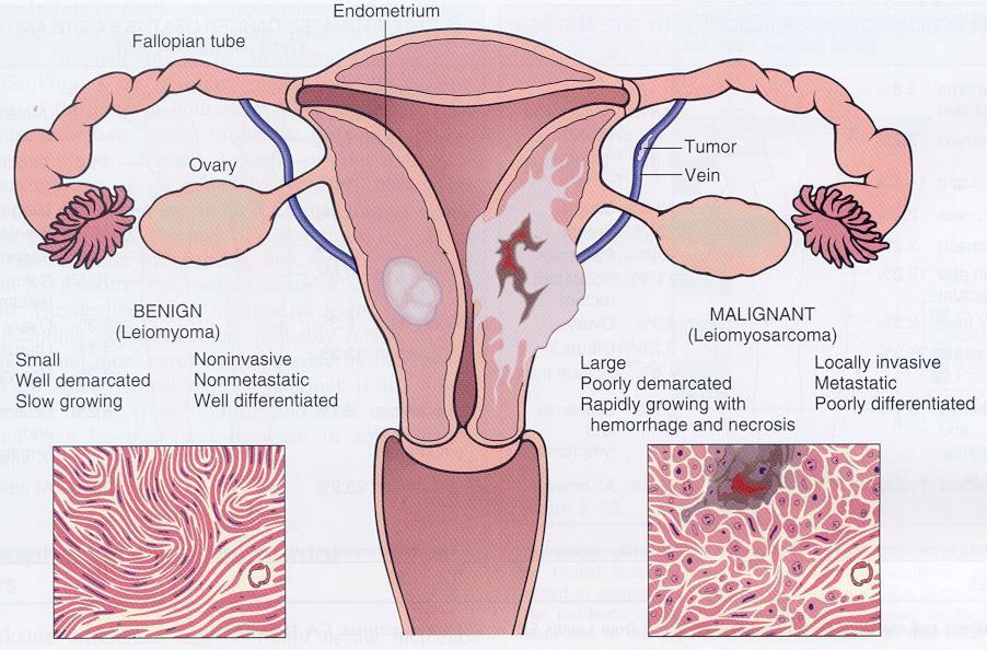 Comparison between a benign tumor of the myometrium
