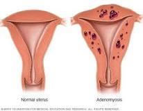 Adenomyosis Presence of ectopic nests of endometrial glands and